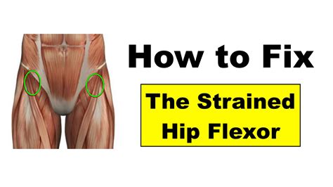 Hip Flexor Tendinopathy