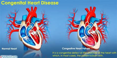 Hereditary Heart Disease Causes, Types, and Treatment