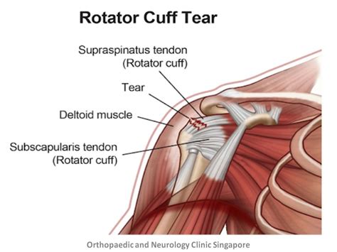 Rotator Cuff Injury Types