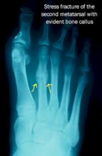 Metatarsal Stress Fracture | Current Health Advice, Health Blog ...