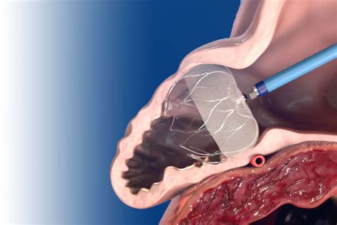 Left Atrial Appendage Closure (LAAC) Therapy – Structural Heart ...