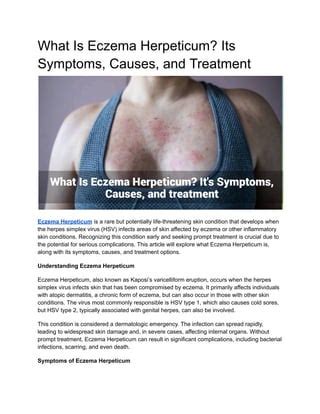 What Is Eczema Herpeticum? Its Symptoms, Causes, and Treatment | PDF