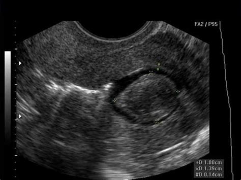 Uterine Fibroids on Ultrasound