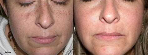 Hyperpigmentation Treatment – Natural, Laser Scar & Black Skin ...