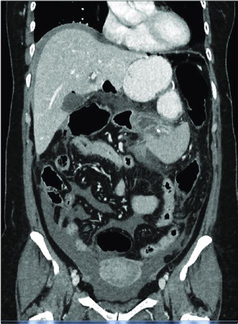 Case 1. Coronal view of the CECT of the abdomen and pelvis. Lesser sac ...