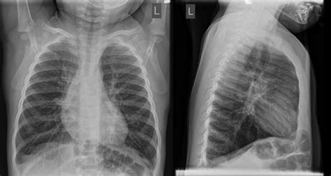 Avoid doing chest x rays in infants with typical bronchiolitis | The BMJ