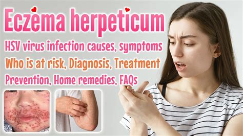 Eczema Herpeticum Overview, Causes, Symptoms, Diagnosis, Treatment ...