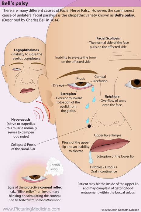 Facial Nerve Palsy Symptoms