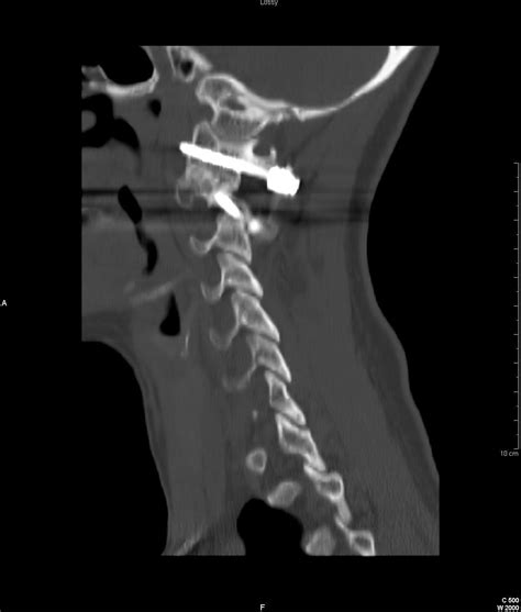 Cureus | Improving C1-C2 Complex Fusion Rates: An Alternate Approach