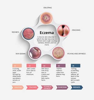 Eczema Herpeticum: Symptoms, Diagnosis, And Treatment | Health soothe