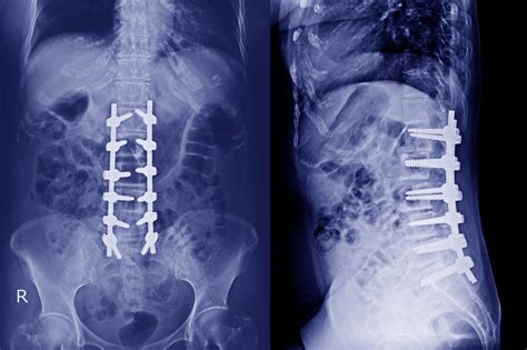 Degenerative Disc Disease: What is It and What's the Treatment Options ...