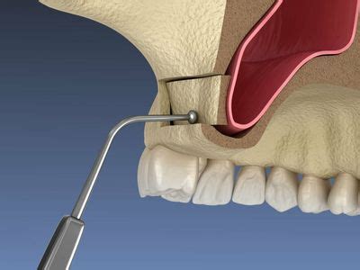 Sinus Lift Surgery: Risks, Benefits & Alternatives