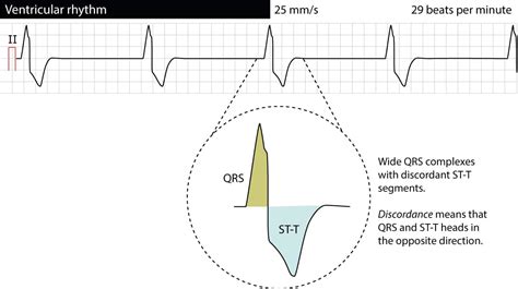 Ventricular rhythm and accelerated ventricular rhythm (idioventricular ...