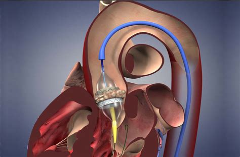 Transcatheter Aortic Valve Replacement for Aortic Stenosis - Penn Medicine