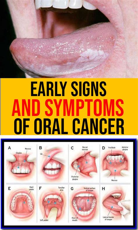 Mouth Cancer Early Warning Signs