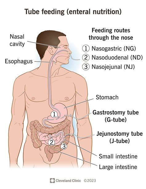 Tube Feeding (Enteral Nutrition): How It Works, Types, Placement