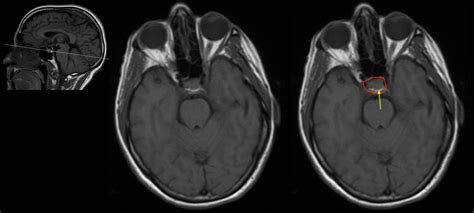 Pituitary Gland Mri