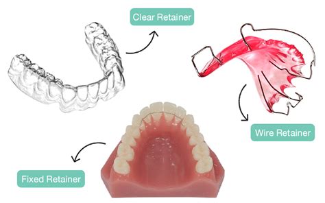 Retainer – AU Dental