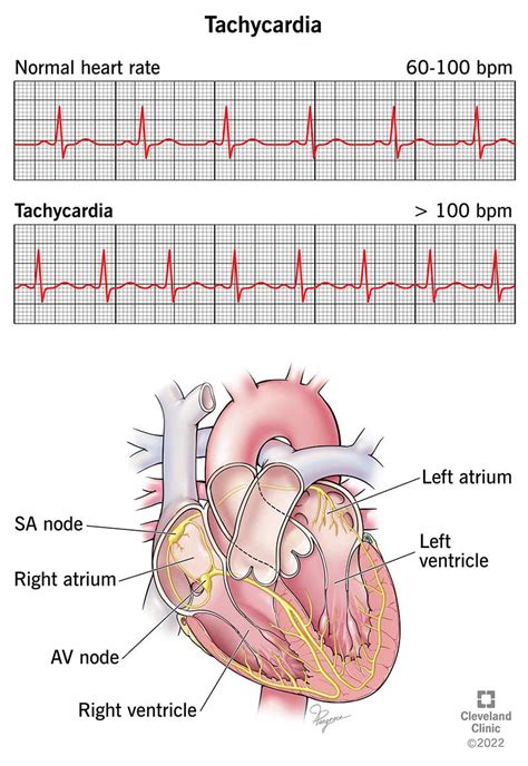 Paroxysmal Atrial Tachycardia Vs Sinus Tachycardia