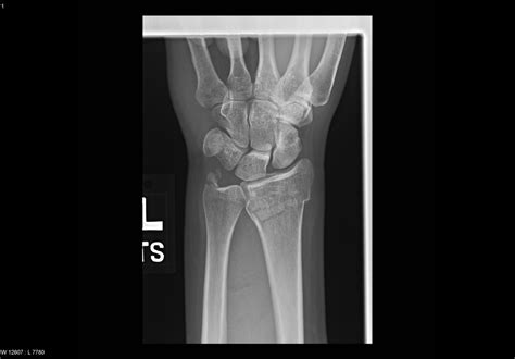 Fracture of distal ulna - Xray - radRounds Radiology Network