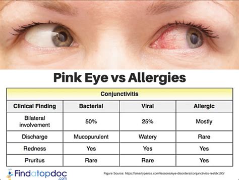 Pink Eye vs. Allergies: Causes, Symptoms, and Treatment