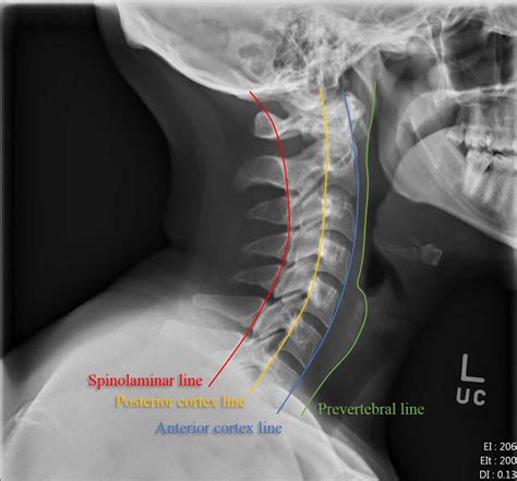 Cervical spine abnormal x ray - sereinstitute