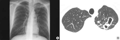 M. kansasii pulmonary disease in a 30-yr-old man. Chest radiograph ...