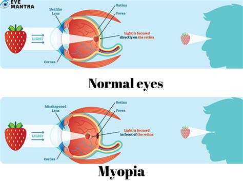 Myopia: Symptoms, Causes And Treatment | Nearsightedness