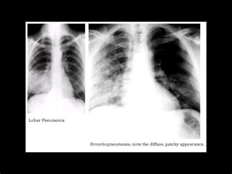 PART I - Pneumonia (Overview, Lobar and Bronchopneumonia) | Doovi