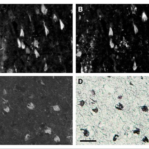 Neuropathologic staining of brain sections from AD patients ...