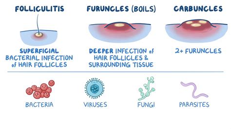 Folliculitis, carbuncles, & furuncles: Nursing - Osmosis Video Library