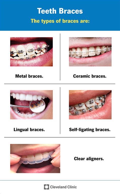 Braces: Types How They Work, 50% OFF | www.pinnaxis.com