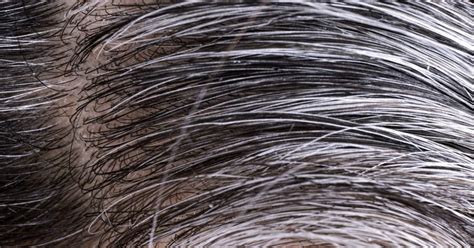 White hair: Causes and ways to prevent it : r/HealthInformation