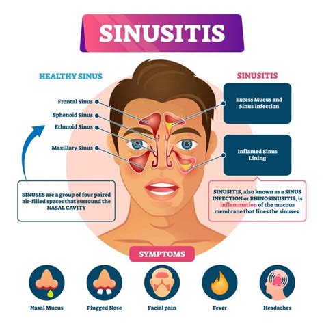 Using The Nasal Neti Pot For Cleansing The Sinus Cavities - Earther Academy