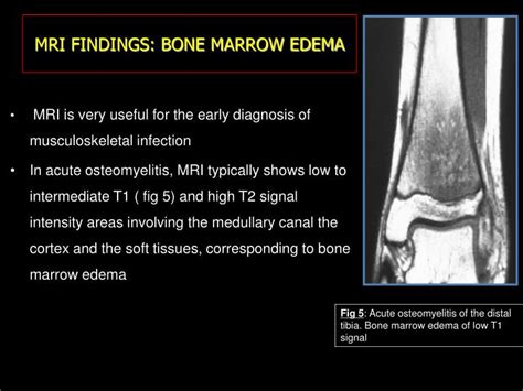 PPT - BONE INFECTION MIMICKING BONE TUMORS: HOW TO MAKE THE DISTINCTION ...