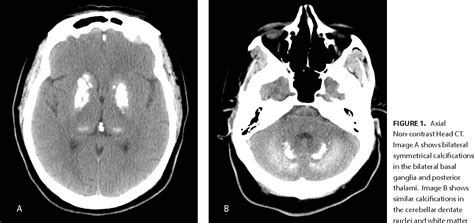 Figure 1 from A Case of Idiopathic Basal Ganglia Calcification and ...