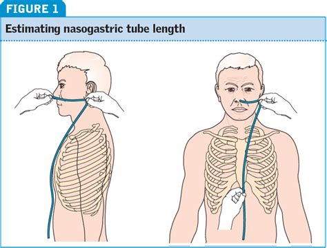 Nasogastric Tube Insertion And Feeding - Riset