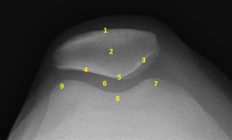 Normal Sunrise Xray : Patellofemoral Joint : Normal knee xray anatomy ...