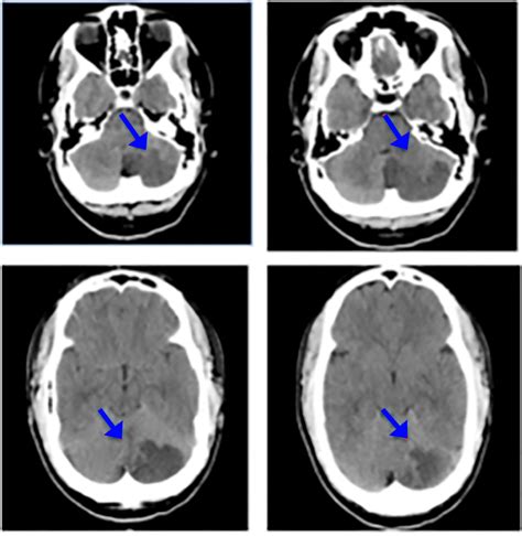 Posterior Inferior Cerebellar Artery Stroke