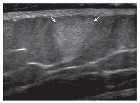 Lipoma. Ultrasound image shows round hyperechoic subcutaneous lipoma ...