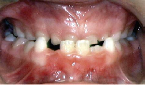 Problems to Look for at Age 7-8: Anterior Crossbite (Underbite)