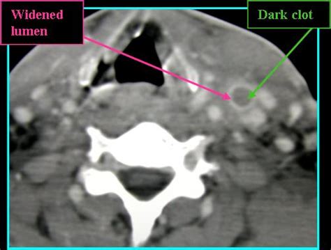 Internal Jugular Vein Thrombosis