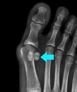 Sesamoid Fractures Virginia Beach, VA | Chronic Fractures Treatment ...