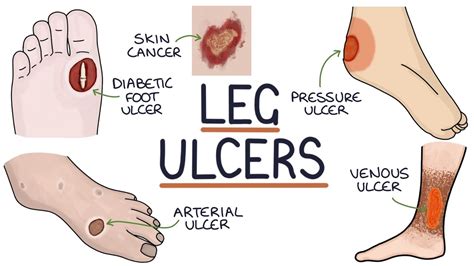 Understanding Leg and Foot Ulcers - Diabetes