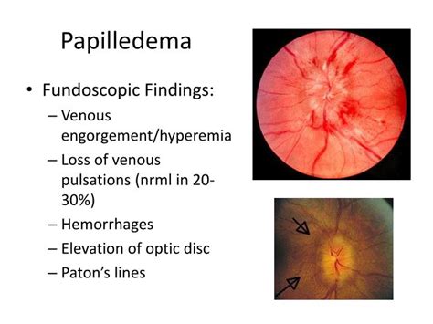 PPT - Stanford Medicine 25 Fundoscopy PowerPoint Presentation - ID:1871147