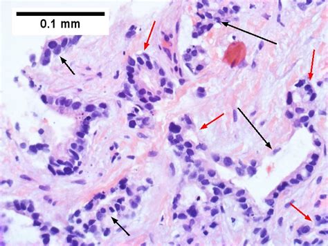 Cholangiocarcinoma - Libre Pathology