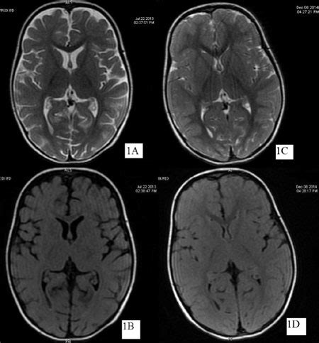 Reversible Cerebral Atrophy in Infantile Tremor Syndrome