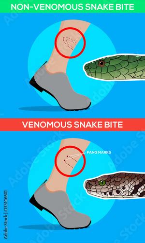 Venomous and non venomous snake bite in the leg. Snakebite. Beware of ...