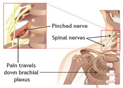 Pinched Nerve in Neck Treatment in New York City