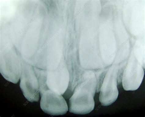 Supernumerary Teeth, X-Ray - Stock Image - C042/9935 - Science Photo ...